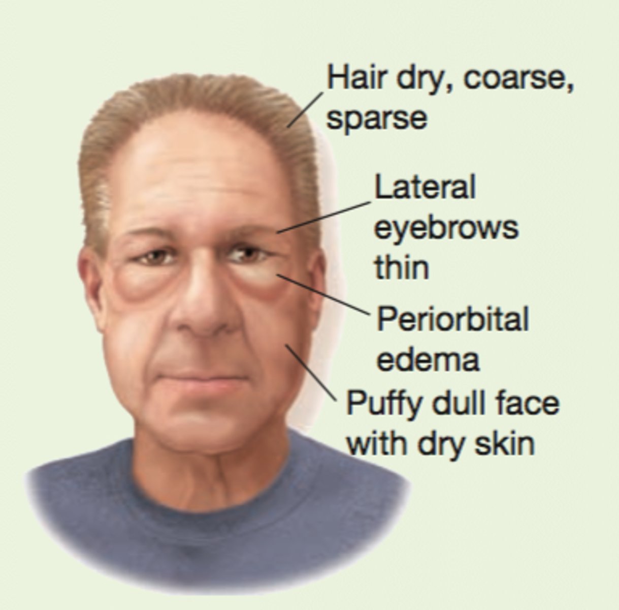 <p>dull, puffy skin</p><p>non pitting periorbital edema</p><p>dry, course, thin eyebrows (missing lat 1/3)</p><p>course, thick skin</p>