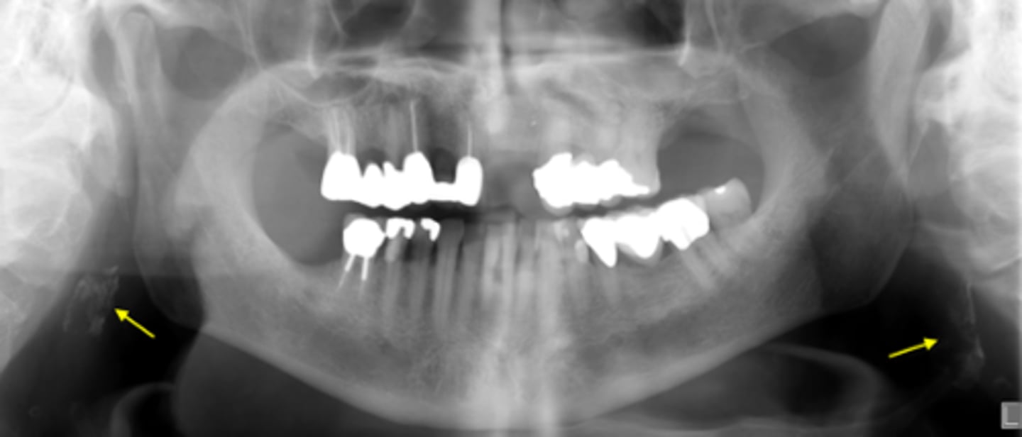 <p>ID the calcified abnormality:</p>