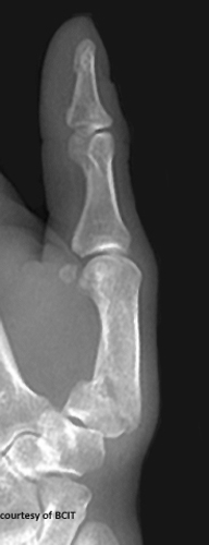 <p>What is the treatment for Bennett's fracture and why is it significant?</p>