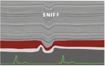 <ul><li><p>patient must stiff</p></li><li><p>M-mode perferred</p></li><li><p>do not measure at Ra junction</p></li><li><p>normal &gt;50%</p></li><li><p>abnormal &lt;50%</p></li></ul><p></p>