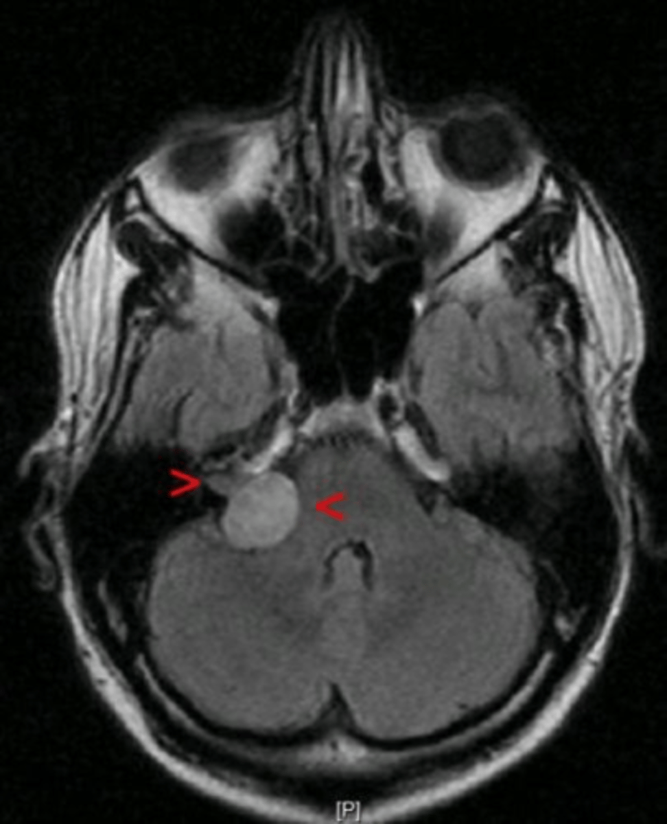 <p>CONTRAST MRI as well as Audiometry as only 5% of patients will have a normal audiogram</p>