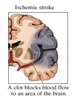 <p>Ischemic stroke</p>