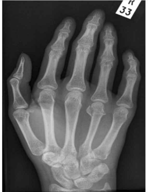 <p>Why is this PA hand poorly positioned? Where is the fracture? </p>