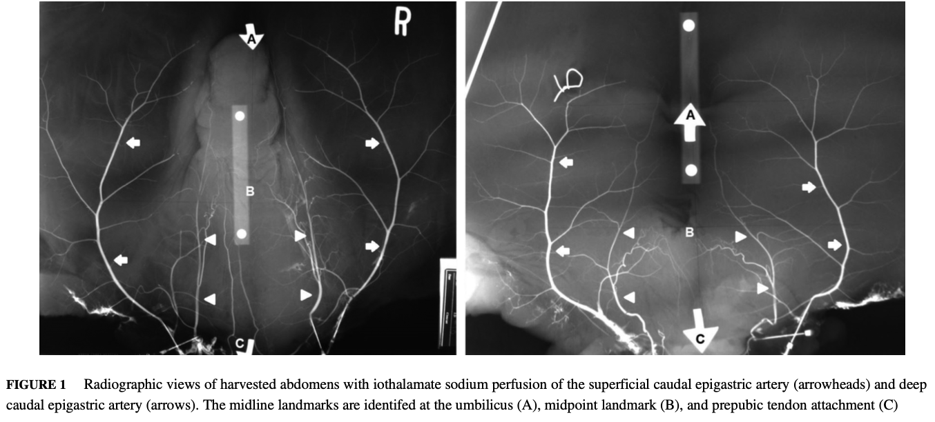 <p>Objective: Determine the location of the deep and superficial caudal epigastric arteries in relation to 3 midline positions and the relationship between the location of these arteries, body circumference, and body condition score</p><p>Results:</p><ul><li><p>The location of the deep caudal epigastric artery correlated with body circumference and body condition score at the umbilicus, midpoint landmark, and prepubic tendon attachment</p></li><li><p>Arteries of heavier condition horses tended to be farther from midline</p></li><li><p>The course of the deep caudal epigastric artery could be estimated by multiplying body circumference by 0.04 at the umbilicus, 0.07 at the midpoint landmark, and 0.03 at the prepubic tendon attachment</p></li><li><p>Orientation of the deep caudal epigastric artery to the umbilicus had the most variation in lateral distanec of the 3 midline landmarks</p></li><li><p>The course of the superficial caudal epigastric artery did not correlate with anatomic landmarks</p></li><li><p>Course of the superficial caudal epigastric artery can be established as a parasagittal line 16-53% of the distance from the midline to the most lateral aspect of the deep caudal epigastric artery path</p></li></ul><p>Conclusion: The course of the deep caudal epigastric artery could be estimated at 3 midline landmarks on the basis of body circumference and body condition score in equine cadavers. Predicting the course of the caudal epigastric arteries may prevent iatrogenic damage during creation of laparoscopic portals</p>