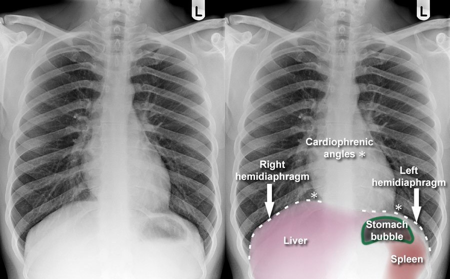 <p>The gastric air bubble (fundus of stomach).</p>
