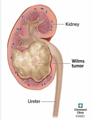 <p>What childhood cancer is this? </p>
