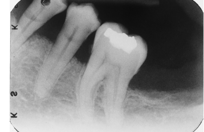 <p>What is seen on the premolars in this image?</p><p>&nbsp;</p><p>toothbrush abrasion</p><p>&nbsp;</p><p>abfractions</p><p>&nbsp;</p><p>cervical caries</p><p>&nbsp;</p><p>cervical restorations</p>
