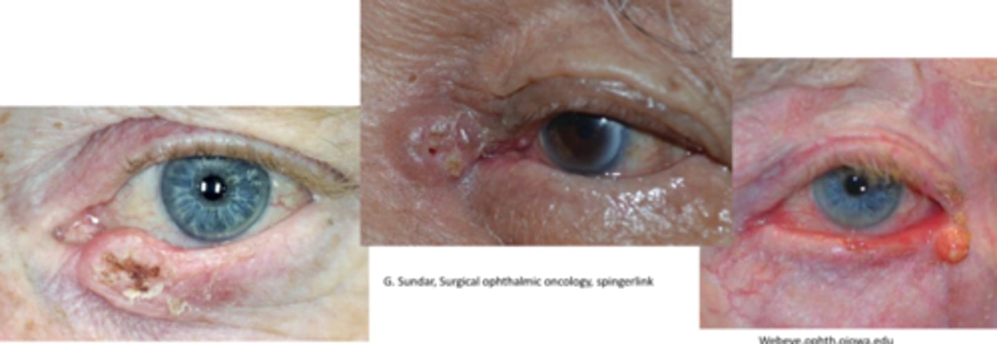 <p>SCC more often on LL</p><p>more UL lesions are SCC</p>