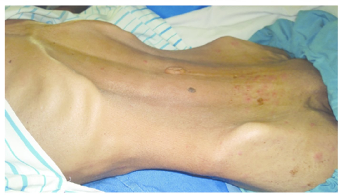 <p>a concave shaped abdomen; seen in adolescents, young adults, and thin adults</p>