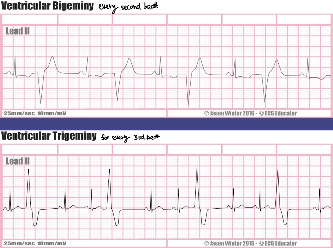 <ul><li><p><strong>Definition:</strong> Every <strong>third beat is a PVC</strong> (two normal beats → PVC → two normal beats → PVC …)</p></li><li><p><strong>Clinical significance:</strong></p><ul><li><p>Shows <strong>ventricular irritability</strong>, usually less frequent than bigeminy but still abnormal</p></li><li><p>Can progress to more serious arrhythmias if underlying cause not addressed</p></li></ul></li><li><p><strong>Nursing actions:</strong></p><ul><li><p>Same as bigeminy: monitor <strong>ECG, vital signs, and patient symptoms</strong></p></li><li><p>Assess <strong>electrolytes, oxygenation, and cardiac history</strong></p></li><li><p>Notify provider if <strong>PVCs increase in frequency, become multifocal, or show R-on-T phenomenon</strong></p></li></ul></li></ul><p></p>