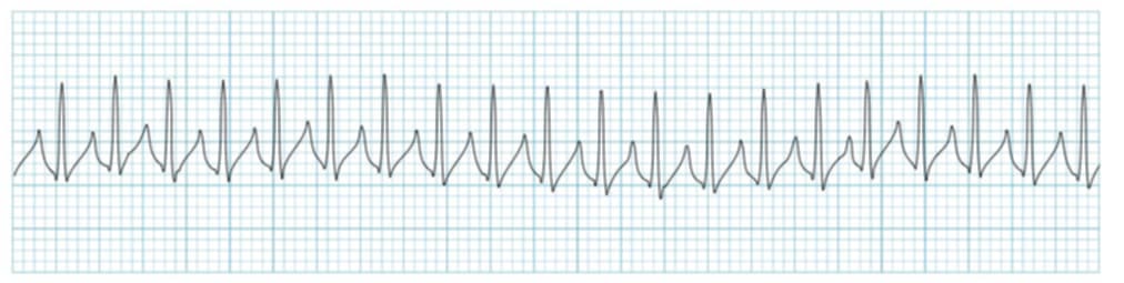 <p>what rhythm is shown in the ECG?</p>