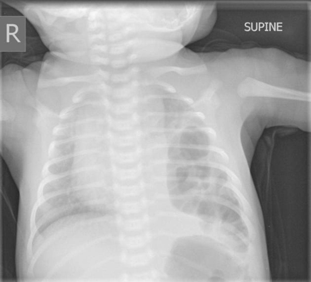 <p>Baby is born w/ respiratory distress, scaphoid abdomen & this CXR.</p><p>• Biggest concern?</p><p>• Best treatment?</p>