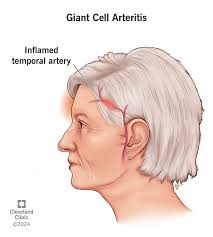 <p><strong>Giant Cell Arteritis: General Info</strong></p><p>-Systemic __________ (inflammation) affecting medium and large size vessels </p><p>-Frequently coexists with polymyalgia rheumatica</p><p>-Peak incidence in patients __-__ years old </p><p>-_______ &gt; men</p><p>-Risk Factors: increased ___, genetic predisposition, history of smoking, early ________, and lower BMI</p>