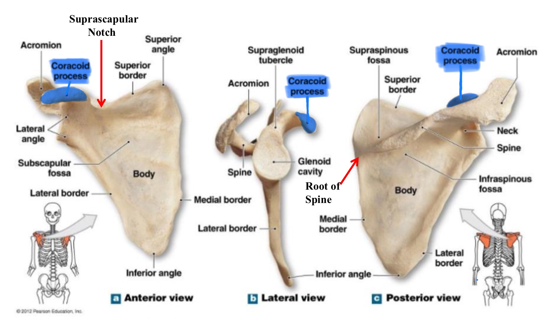 <p>coracoid process of scapula</p>