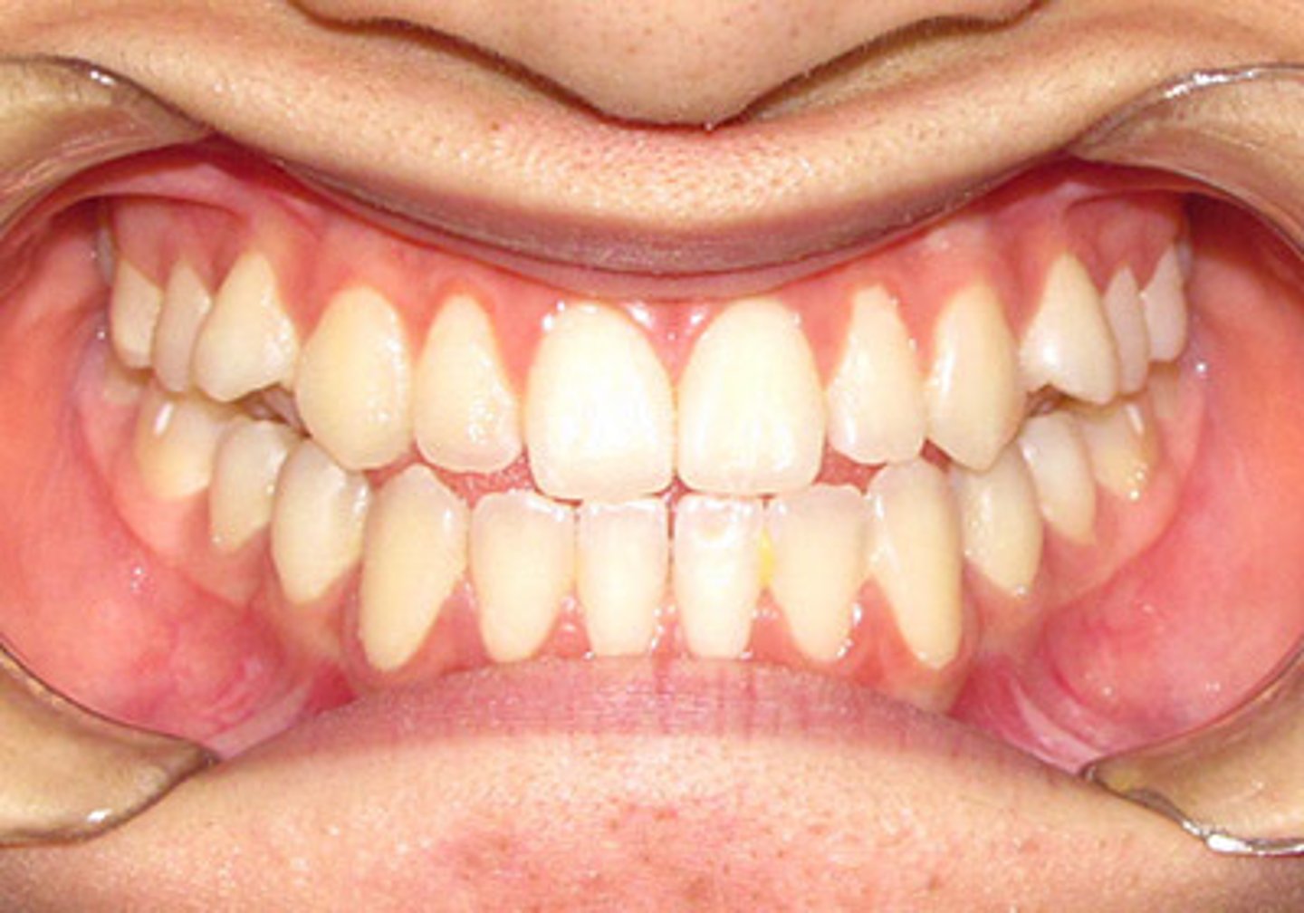 <p>Incisal edges occlude</p>