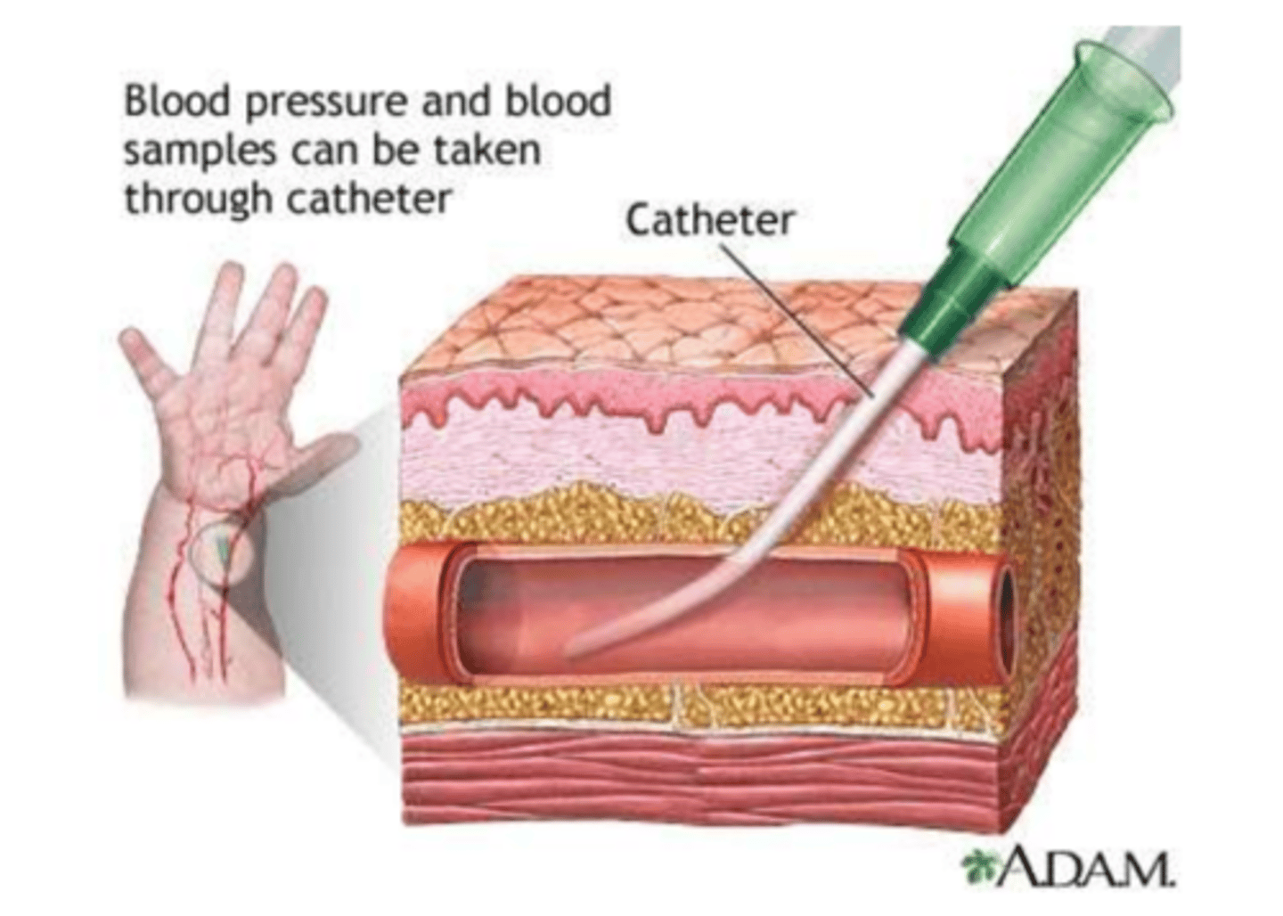 <p>PT Implications of Arterial Line:</p><p>- If displaced, apply immediate and direct __________________________</p><p>- Femoral: Hip flexion past ________________________ contraindicated for femoral arterial line. After removal, bedrest for _________________________ </p><p>- Radial: May see _________________________</p>