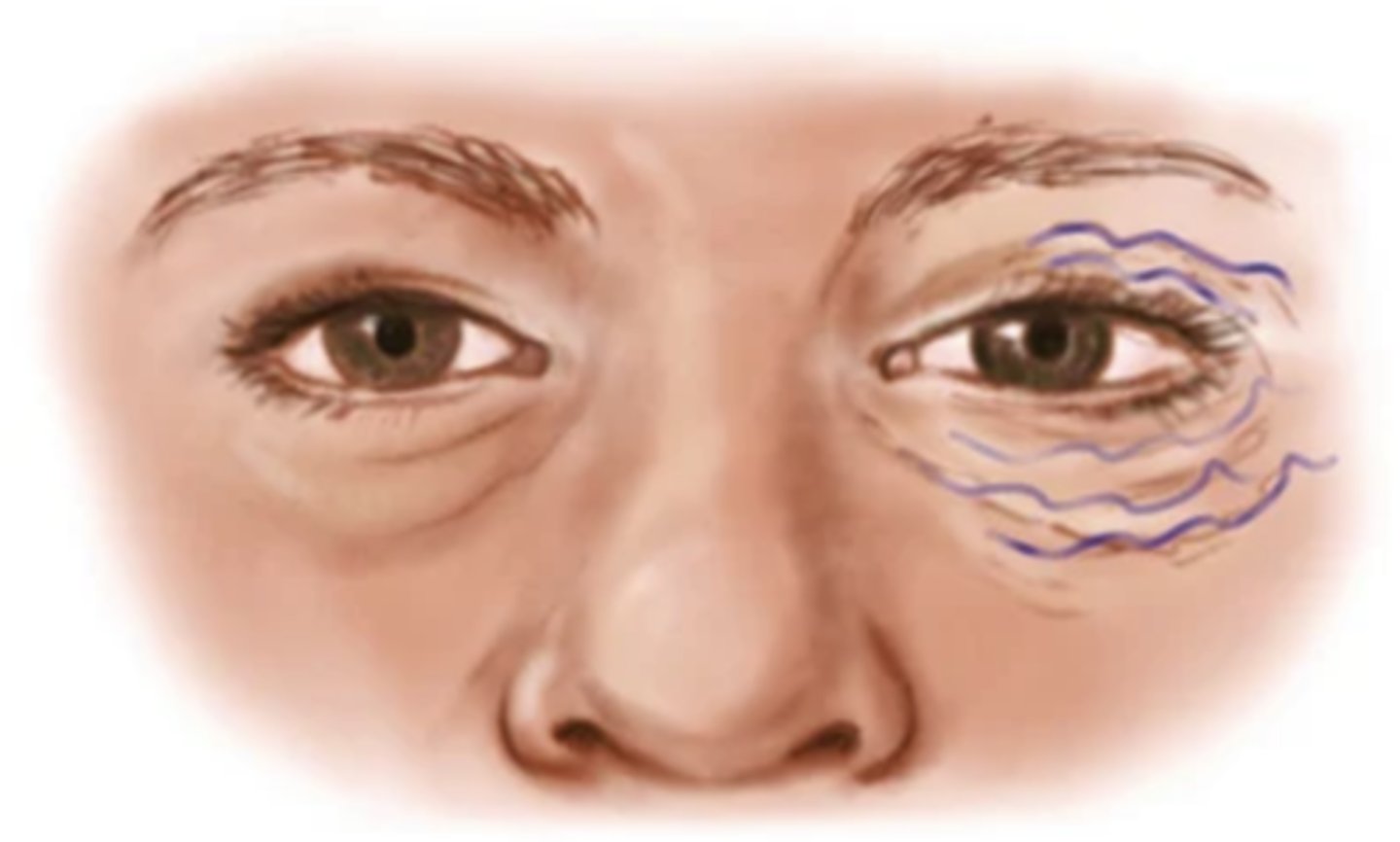 <p>When a resting muscle twitches</p>