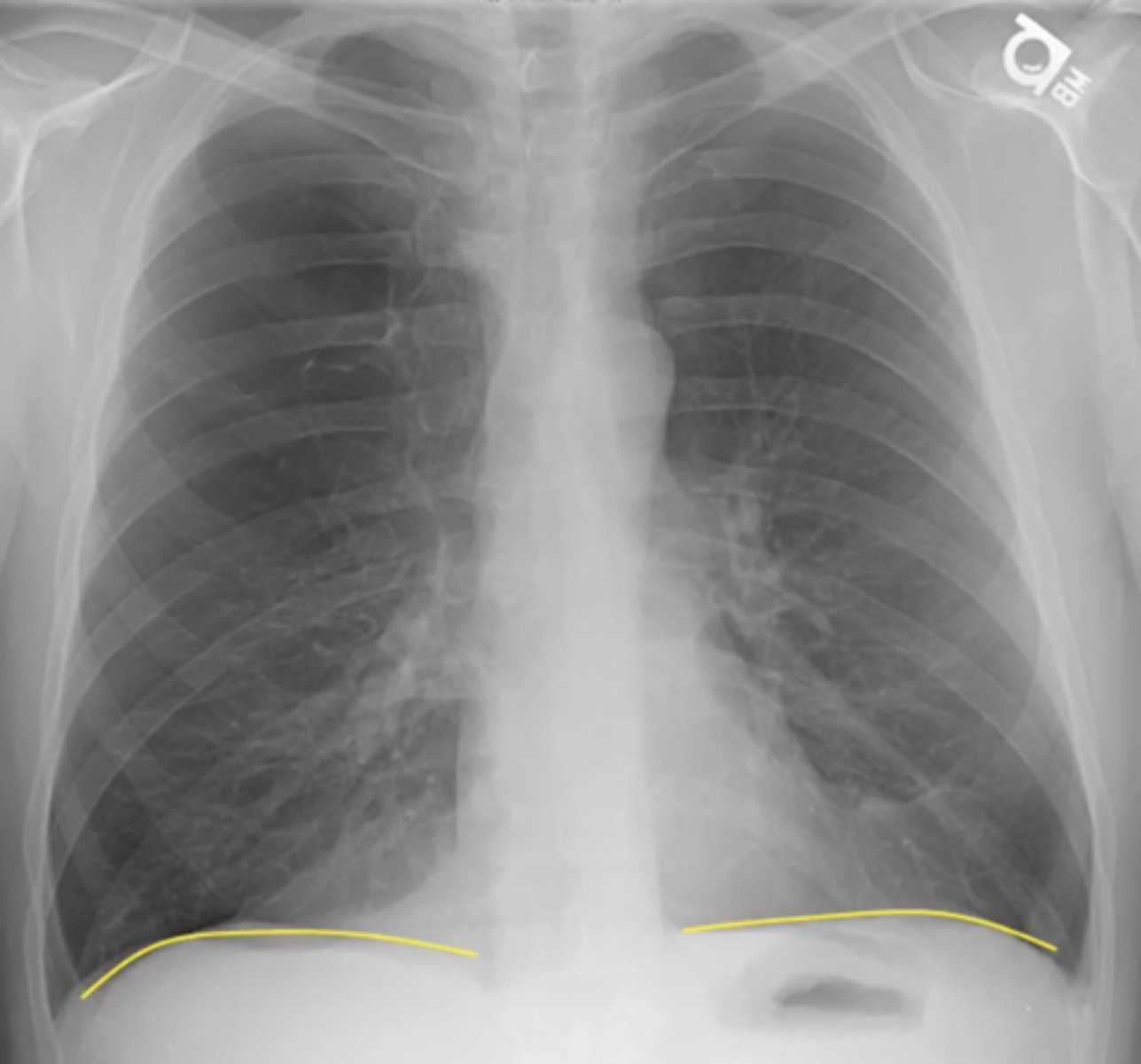 <p>(evaluating AP CXR) seen in diagnosis of COPD bc of hyperextension of lungs</p>