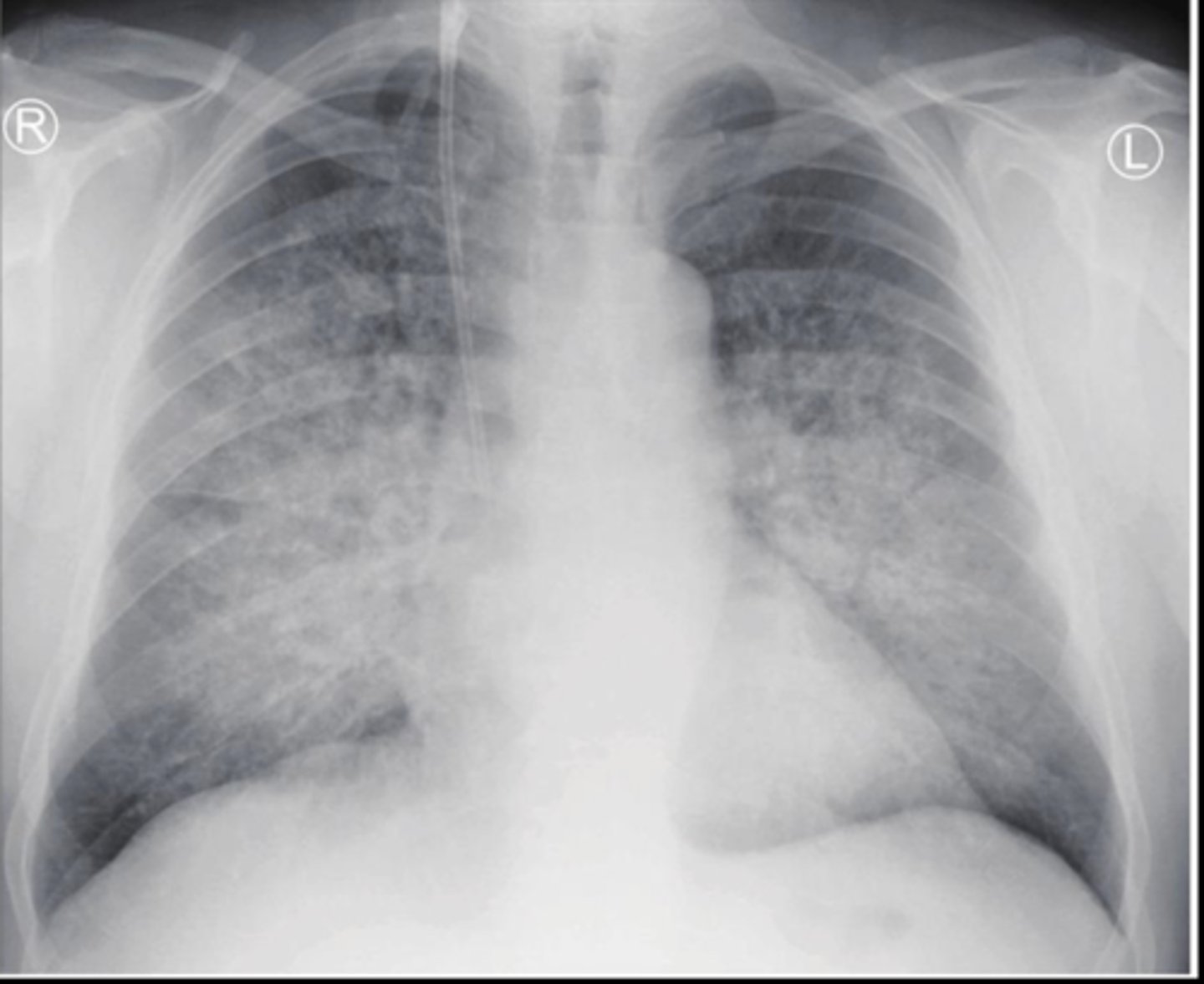 <p>What do you see in this image, alveolar or interstitial?</p>
