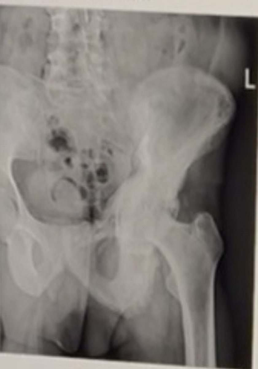 <p>63 year old male. What is the most likely lab finding and what is the next step in Managment</p>