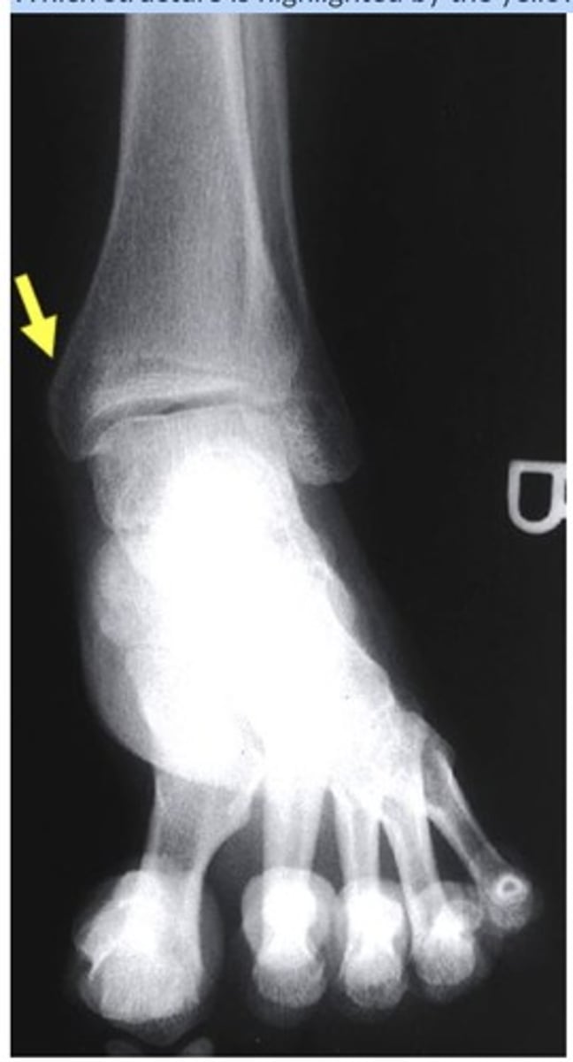 <p>medial malleolus</p><p>3 multiple choice options</p>