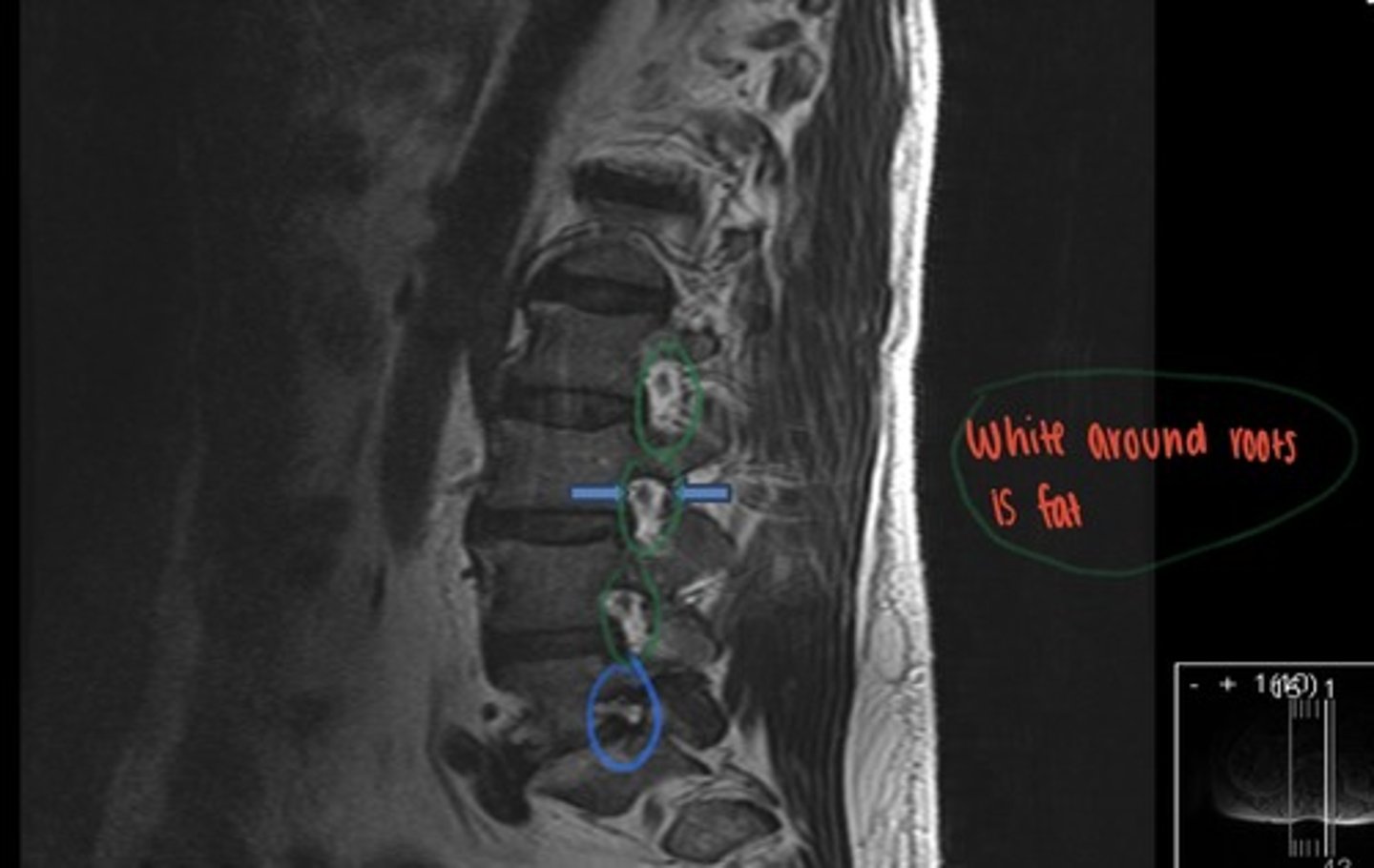 <p>what is this image?</p><p>what is between the blue arrows?</p><p>what abnormality is seen on this image?</p>
