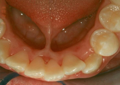 <p>abnormally shot, thick lingual frenum that restricts tongue movement </p>