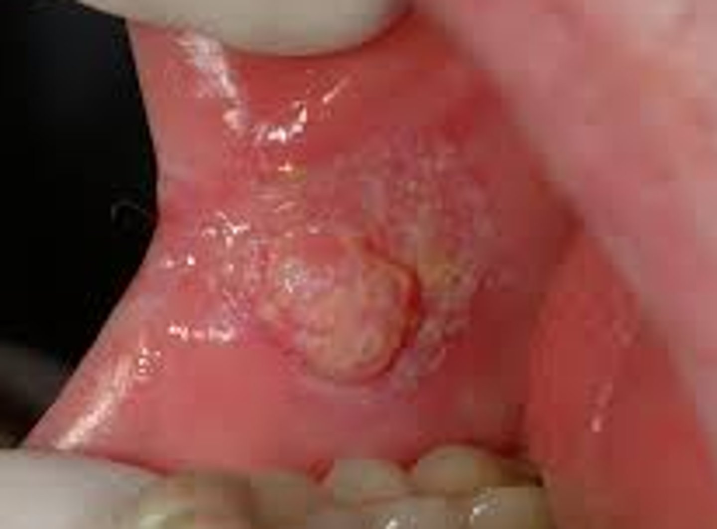 <p>HPV 16 and 18</p>