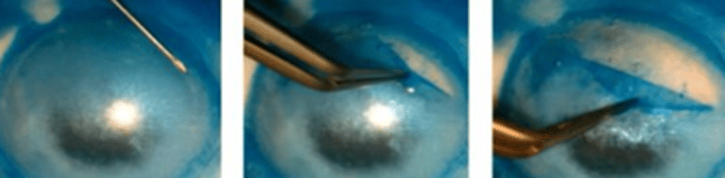 <p>Explain the general process of retrieving donor Bowman's in a BLT.</p>