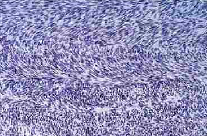 <p>rare soft tissue tumor that <strong><span style="color: red">occurs mostly in the retroperitoneum, thigh, knee, &amp; distal extremities</span></strong></p><ul><li><p><strong><mark data-color="blue">encapsulated, infiltrative, soft, fish flesh masses with areas of hemorrhage &amp; necrosis</mark></strong></p></li><li><p><strong><mark data-color="blue">highly cellular neoplasm of spindle cells growing in a </mark><span style="color: purple"><mark data-color="blue">herringbone (or basket-weave)</mark></span><mark data-color="blue"> fashion </mark></strong>which nuclear pleomorphism &amp; frequent mitosis </p></li></ul>