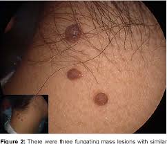 <p>What type of skin lesion is this? Give an example.</p>
