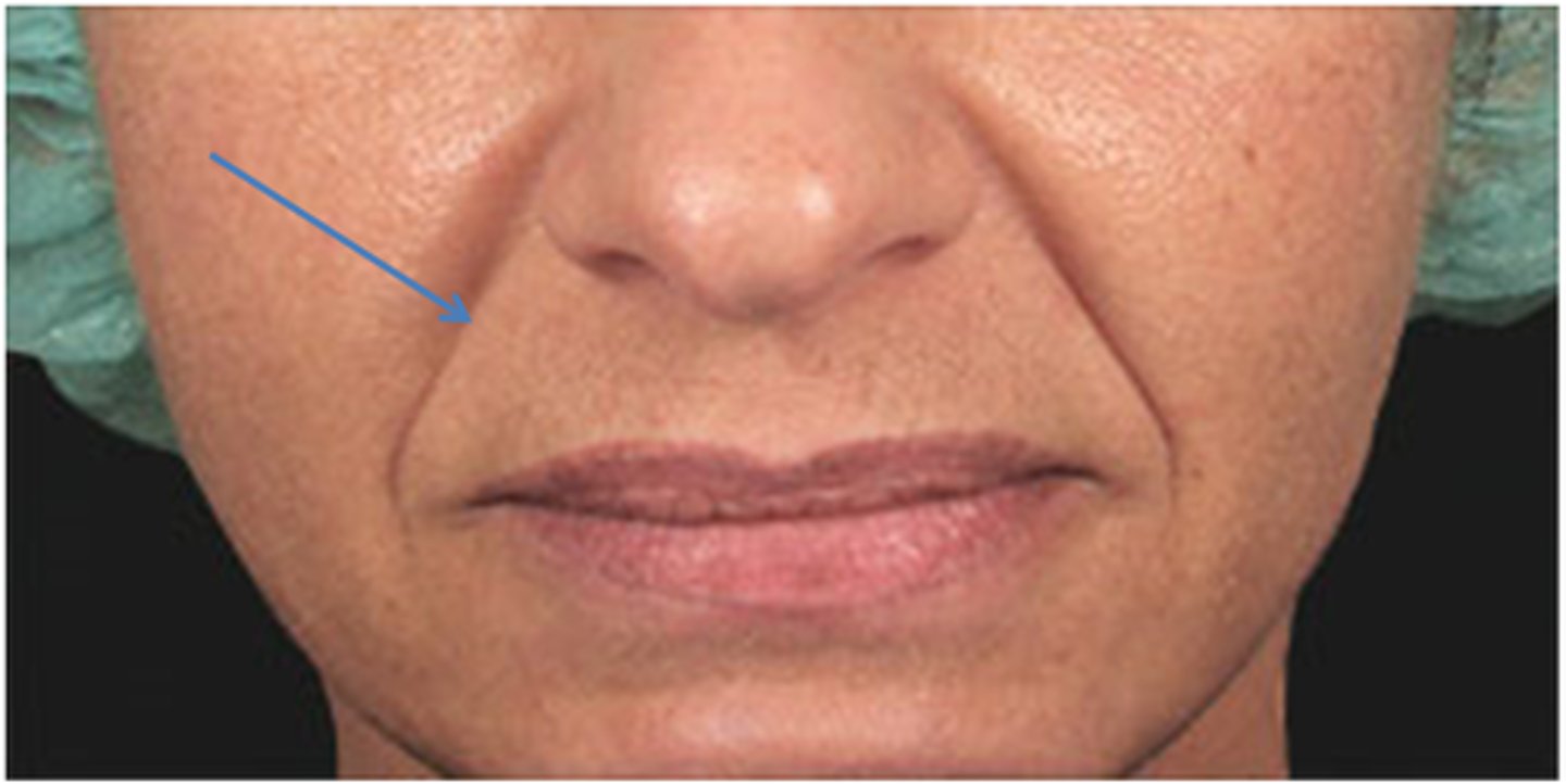 <p>nasolabial folds deepen when one smiles; acquired</p><p>furrow which may develop along the margin of nasolabial fold</p>