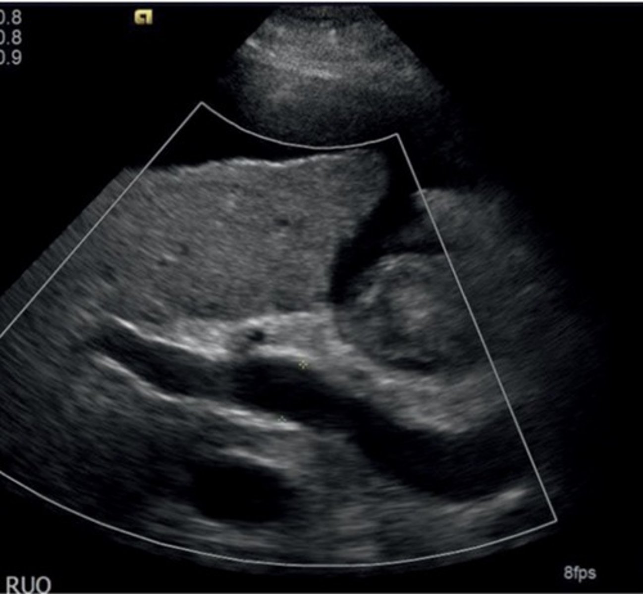 <p>Large pulmonary vein</p><p>Collaterals</p><p>Splenomegaly</p><p>Ascites</p><p>Enlarged hepatic artery</p>