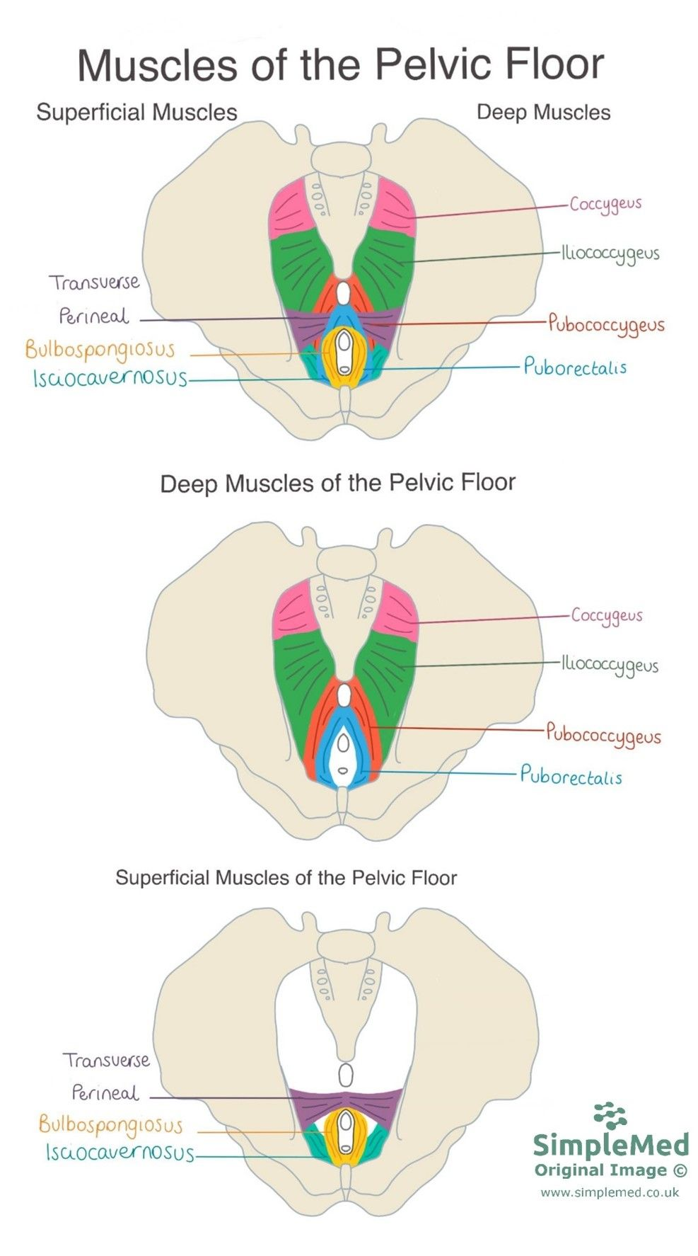 <p>D. It is tensed during defecation</p><p>The pelvic floor is not tensed during defecation--it is relaxed so that feces can be released from the rectum</p><ul><li><p><strong>pelvic floor</strong> (or pelvic diaphragm) is a <strong>funnel-shaped sheet of skeletal muscles</strong> that <strong>supports pelvic organs</strong> (B and C are correct)</p></li><li><p>forms the <strong>inferior boundary of the true pelvic cavity</strong>, together with the pelvic brim defining the true pelvis (A is correct)</p></li><li><p><strong>projects into the anal triangle</strong> of the perineum (E is correct)</p></li></ul><p></p>