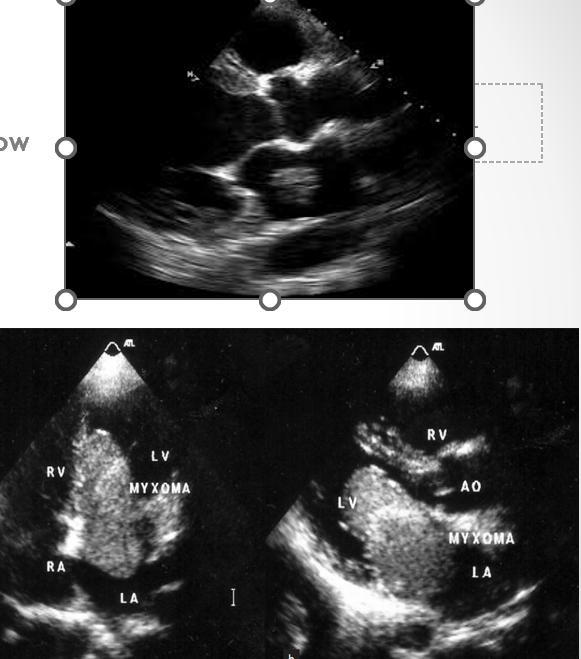 <p>non rheumatic form of mitral stenosis where tumor prolapses into mitral valve funnel in diastole and produces inflow obstruction&nbsp;</p>