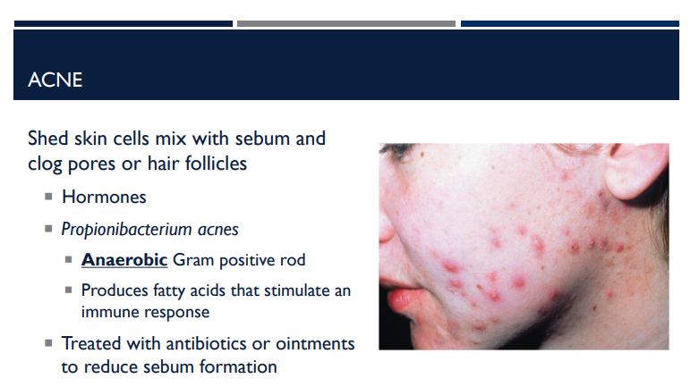 <p>What is the bacteria name for acne?</p>