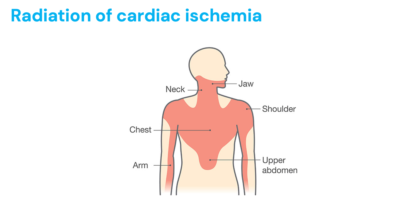 <ul><li><p>Ischemia causes pain, typically radiating to these areas&nbsp;</p></li><li><p>“Crushing, vice like pain”&nbsp;</p></li><li><p>DM&lt; females, older adults more likley to have different sex, fatigue&nbsp;</p></li></ul><p></p>