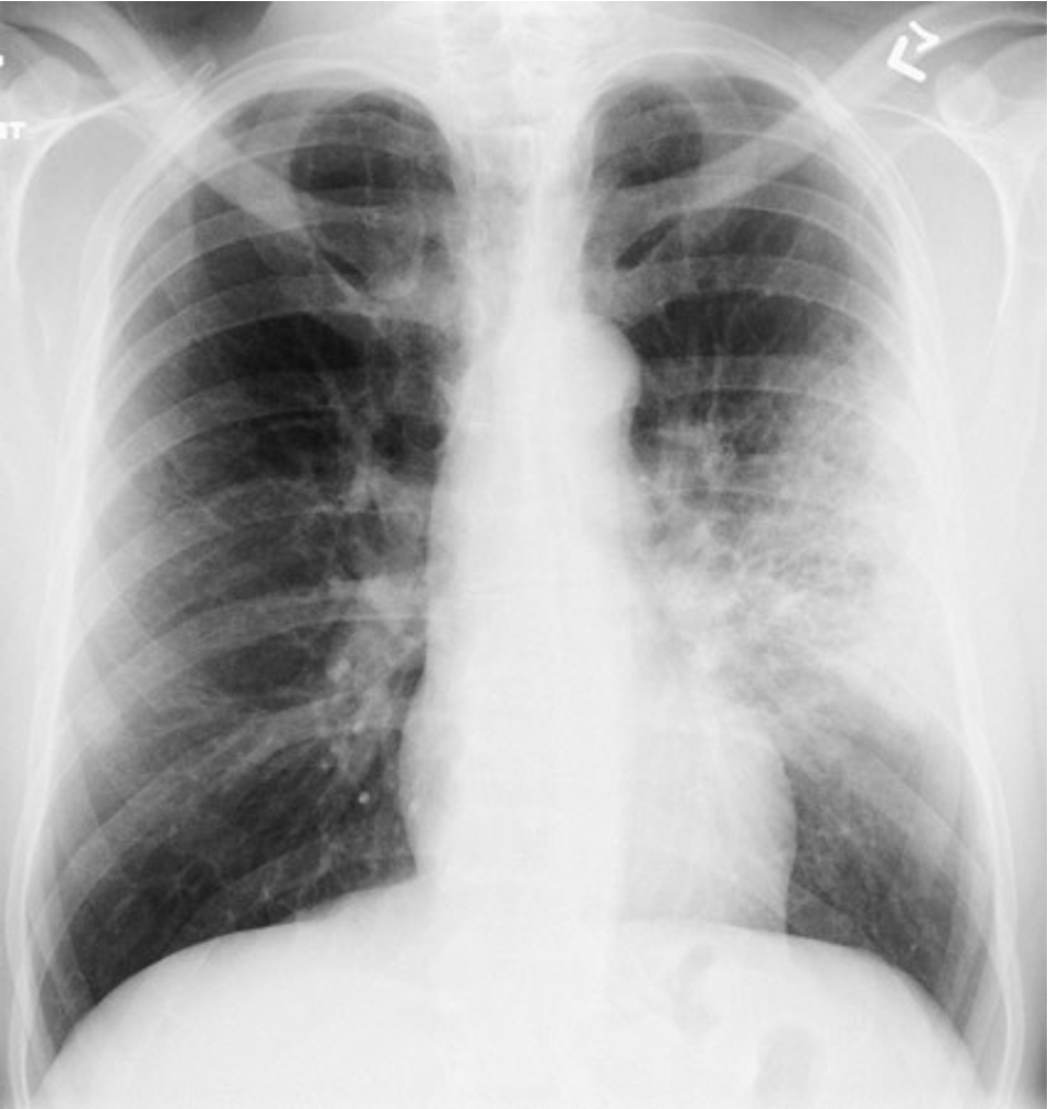 <p><strong>Lung Infitrate:</strong></p>