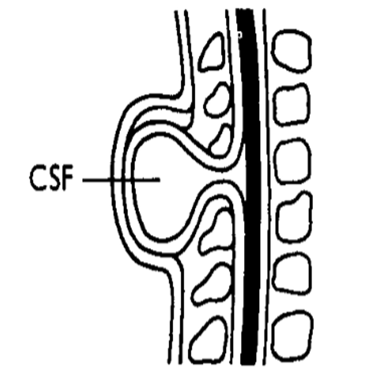 <p>Sac-like cyst of meninges filled with spinal fluid, usually with no involvement of spinal cord, but possible spinal abnormalities.</p>