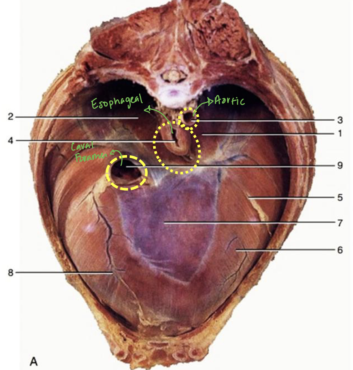 <p><strong><u>What are the 3 openings:</u></strong></p><ul><li><p><span style="color: green"><strong><mark data-color="green" style="background-color: green; color: inherit">Aortic Hiatus </mark></strong></span></p><ul><li><p><strong><u>Contains:</u> </strong></p><ul><li><p><span style="color: green"><strong>Aorta </strong></span></p></li><li><p><span style="color: green"><strong>Azygous vein </strong></span></p></li><li><p><span style="color: green"><strong>Thoracic duct </strong></span>(<em>lymphatic vessels</em>) </p></li></ul></li><li><p><strong><u>Location:</u> Most dorsal </strong></p></li></ul></li><li><p><span style="color: green"><strong><mark data-color="green" style="background-color: green; color: inherit">Esophageal Hiatus </mark></strong></span></p><ul><li><p><strong><u>Contains:</u> </strong></p><ul><li><p><span style="color: green"><strong>Esophagus </strong></span></p></li><li><p><span style="color: green"><strong>Dorsal</strong></span><strong> </strong>and<span style="color: green"> <strong>ventral vagal nerves </strong></span></p></li><li><p><span style="color: green"><strong>Vessels </strong></span></p></li></ul></li></ul></li><li><p><span style="color: green"><strong><mark data-color="green" style="background-color: green; color: inherit">Caval Foramen </mark></strong></span></p><ul><li><p><strong><u>Contains:</u> </strong><span style="color: green"><strong>Caudal vena cava </strong></span></p></li><li><p><strong><u>Location:</u> </strong><span style="color: green"><strong>Dorsal</strong></span><strong> </strong>to <span style="color: green"><strong>tendinous center </strong></span>of <span style="color: green"><strong>diaphragm</strong></span><strong> </strong></p></li></ul></li></ul><p><strong><u>Which opening doesn’t allow movement:</u></strong><span style="color: green"><strong> Caval foramen</strong></span></p><ul><li><p><strong><u>Why:</u> </strong><span style="color: green"><strong>Tendon</strong></span><strong> </strong>fused with <span style="color: green"><strong>adventitia</strong></span><strong> </strong>of <span style="color: green"><strong>vessels</strong></span></p></li></ul><p></p><p></p>
