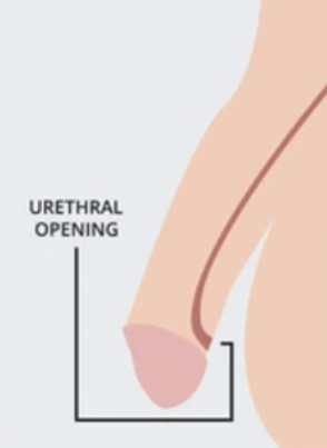 <p>a congenital condition where the opening of the urethra is located on the <strong>underside</strong> of the penis instead of at the tip.</p>
