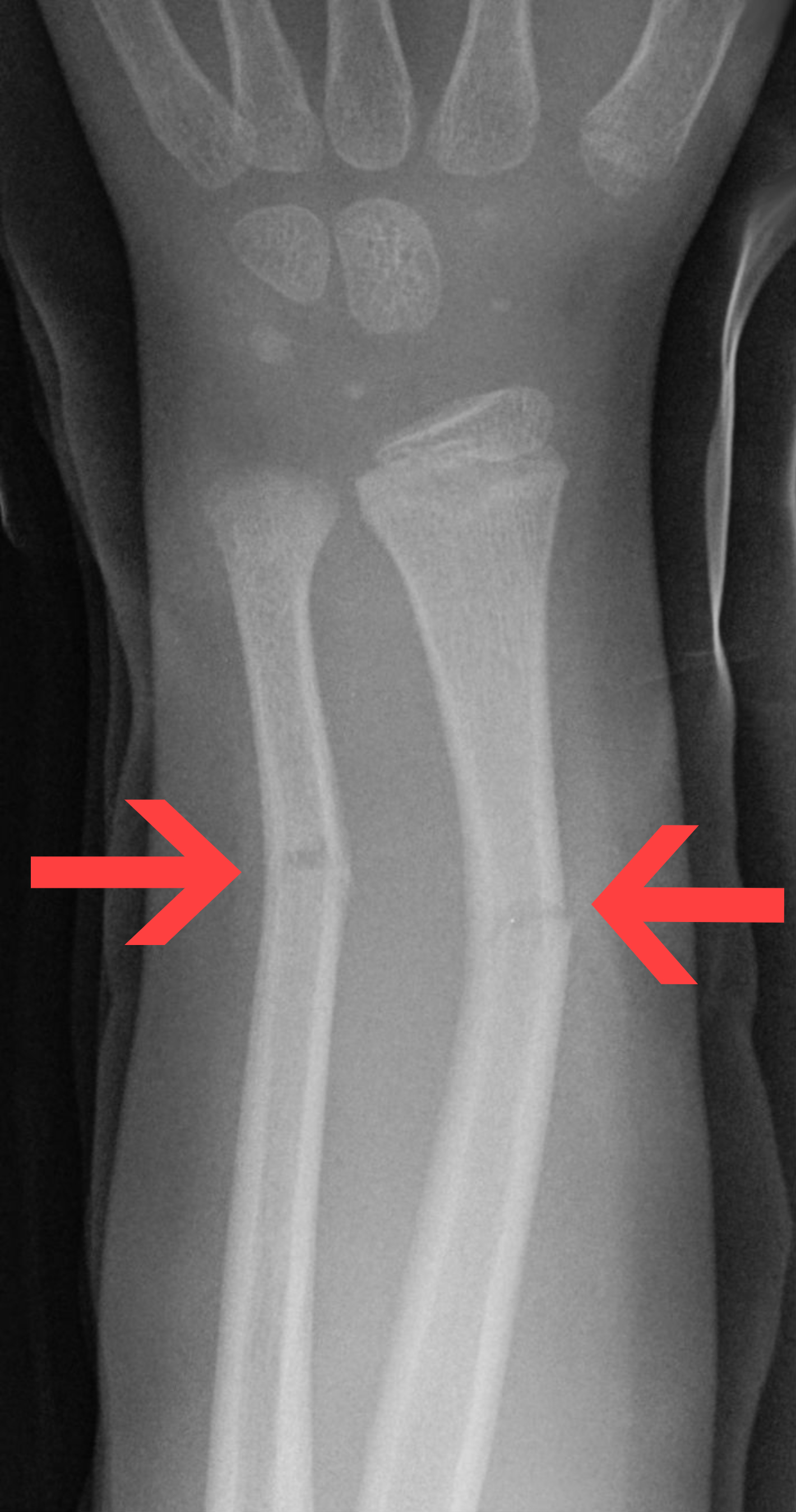<p>partial fracture that occurs in children; one side of bone is broken, other</p><p>side is bent</p>