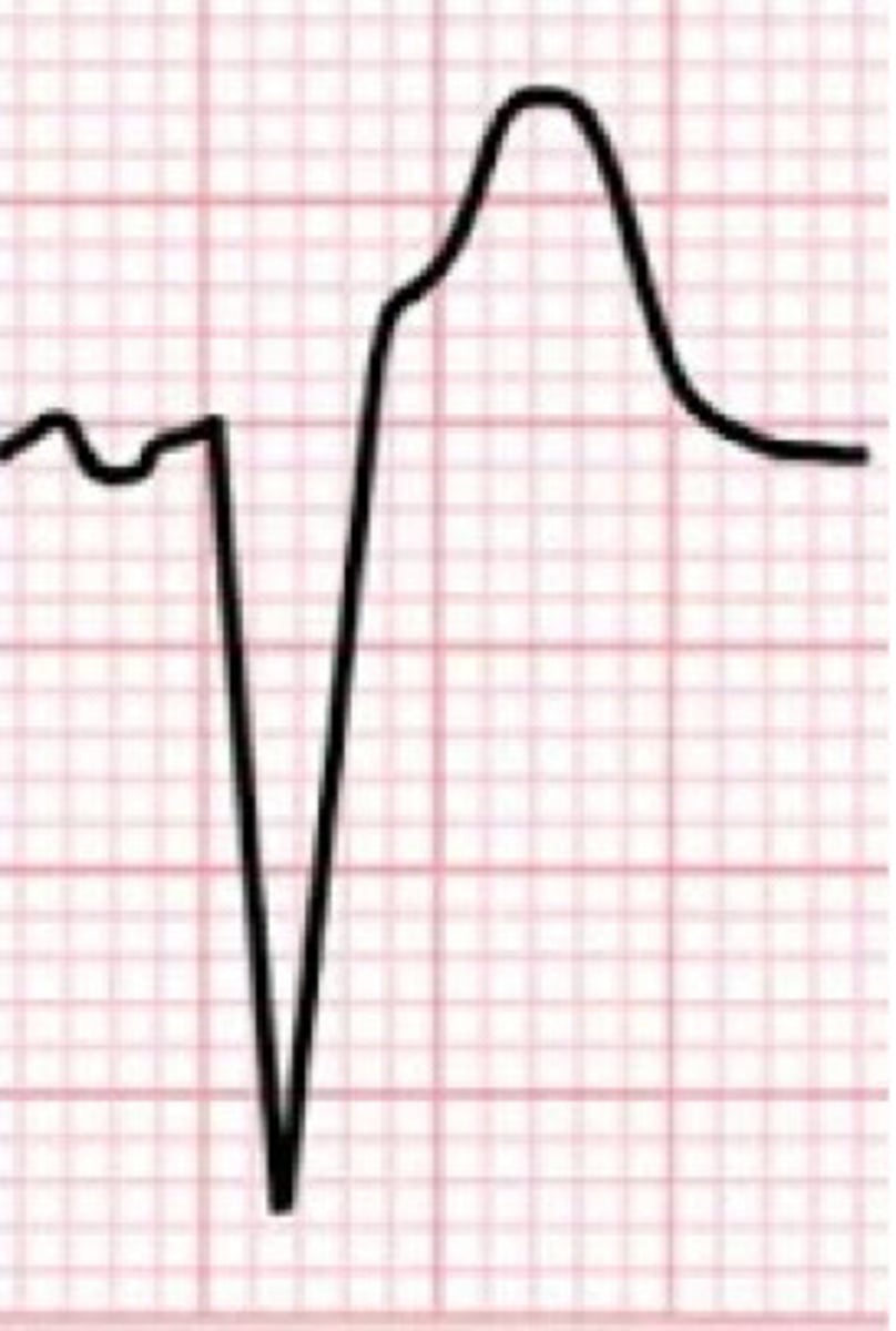 <p>What arrhythmia does this image represent</p>