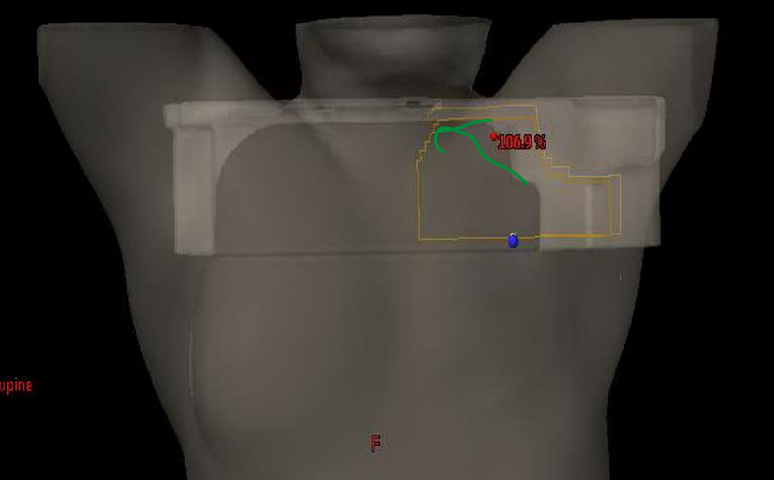 <p>what are the MLCs the arrow is pointing to shielding?</p>