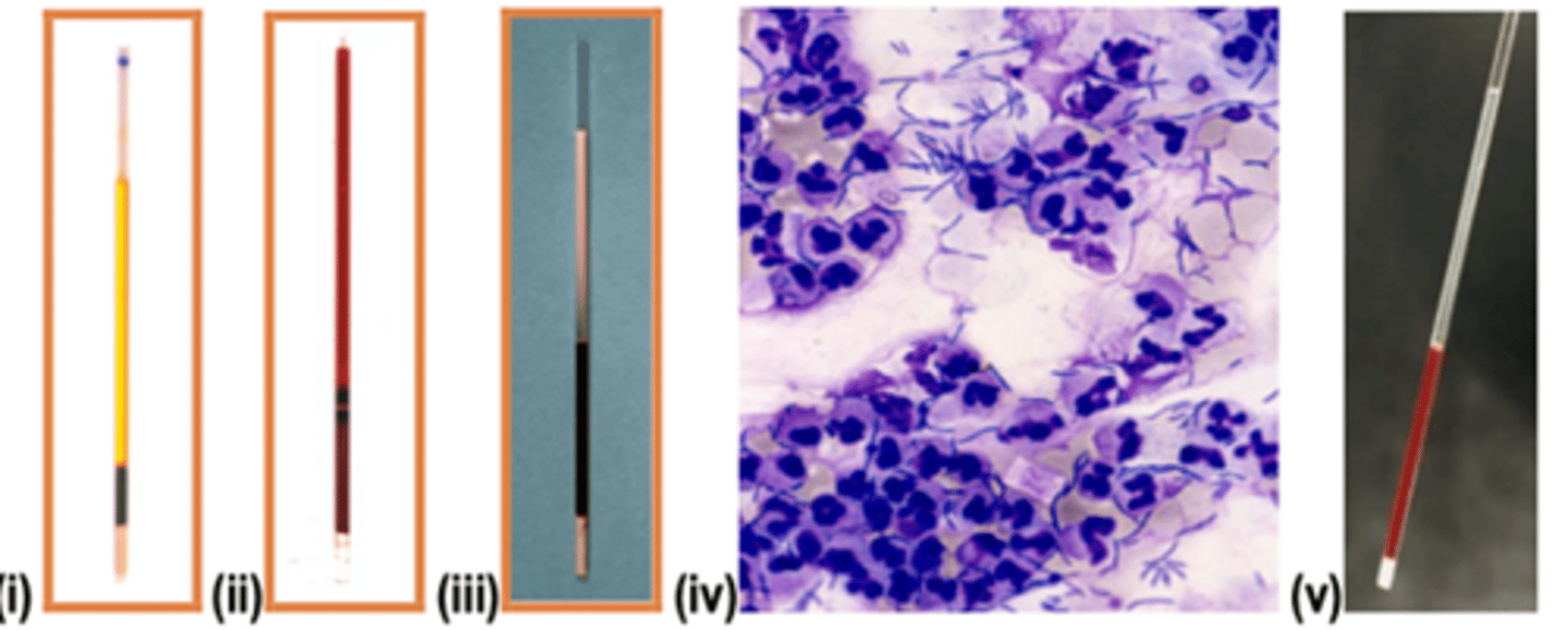 <p>Which condition is most consistent with extravascular immune-mediated hemolytic anemia?</p>