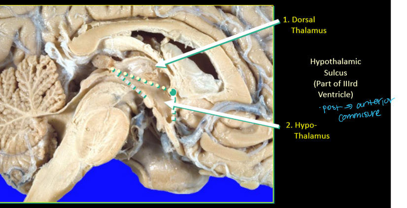 <p>posterior commisure to anterior commisure </p><p>part of 3rd ventricle </p>