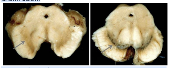 <p>A 70-year-old male has been suffering from frequent falls. His muscles are rigid and his fingers exhibit tremors at rest. After his demise, an autopsy was performed. His brain (LEFT) along with a normal brain (RIGHT) are shown below. Which of the following statements best describes the patient's condition and the symptoms mentioned?</p><p>A. Loss of dopaminergic neurons projecting to the prefrontal cortex</p><p>B. Decreased activity of the tuberoinfundibular tract</p><p>C. Decreased dopaminergic inputs from the midbrain to the basal nuclei/ganglia</p><p>D. Loss of connections from the ventral tegmental area to the limbic cortex</p>