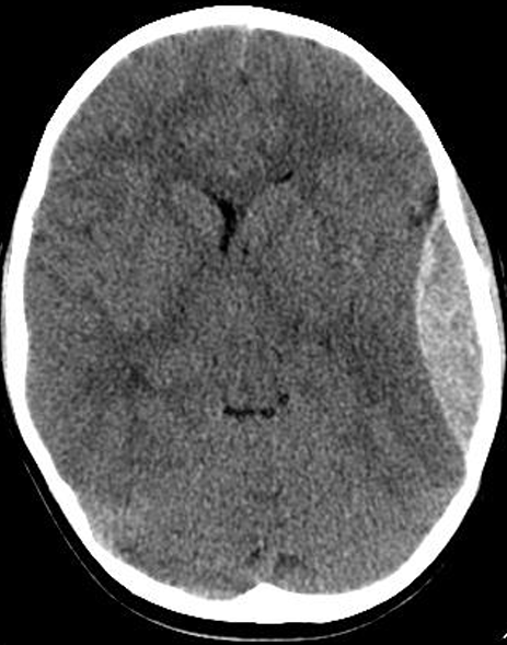 <p>epidural hematoma, subarachnoid hematoma, stroke, or tumor?</p>