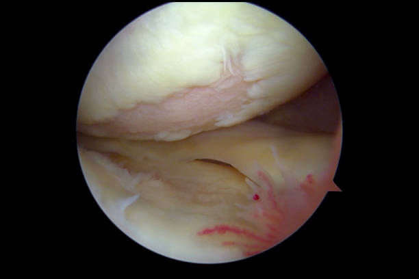 <p>Degeneration of joint cartilage. Causes pain and stiffness. Most common type of arthritis.</p>