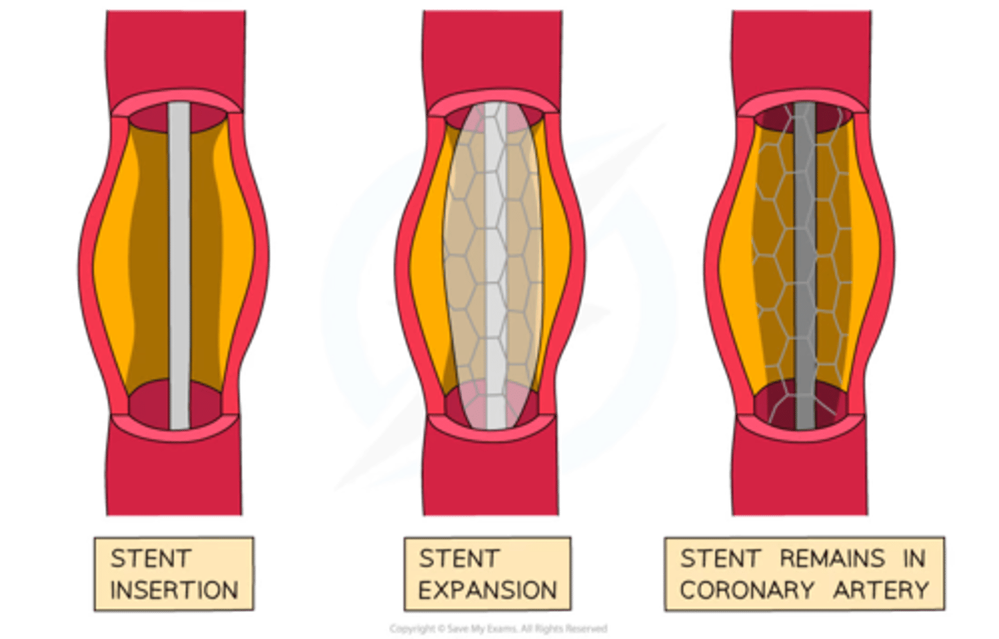 <p>=&gt; specifically, percutaneous coronary intervention<br><br>=&gt; improves blood supply back to heart<br><br>=&gt; works by putting a narrow flexible tube into body and pushing it to coronary artery, then inflating a small balloon to widen the narrowed part of the artery<br><br>=&gt; results in less pain, less breathlessness, more energy, better mood, and reduced risk of heart attack<br>coronary artery bypass surgery</p>